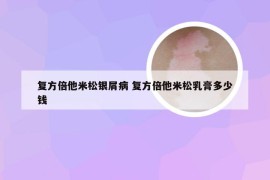 复方倍他米松银屑病 复方倍他米松乳膏多少钱