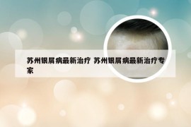 苏州银屑病最新治疗 苏州银屑病最新治疗专家