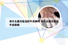 有什么偏方能治好牛皮癣吗 有什么偏方能治牛皮肤癣