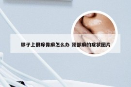 脖子上很痒像癣怎么办 颈部癣的症状图片