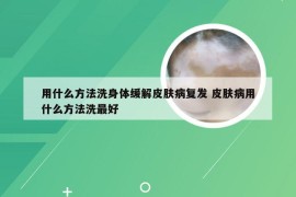 用什么方法洗身体缓解皮肤病复发 皮肤病用什么方法洗最好