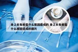身上长有癣是什么原因造成的 身上长有癣是什么原因造成的图片
