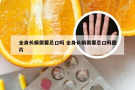 全身长癣需要忌口吗 全身长癣需要忌口吗图片