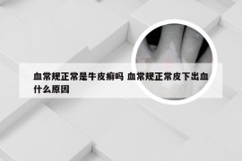 血常规正常是牛皮癣吗 血常规正常皮下出血什么原因