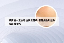 银屑病一定会增加头皮屑吗 银屑病会引起头皮屑增多吗