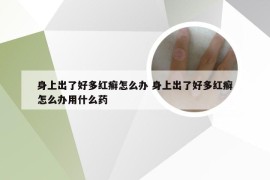 身上出了好多红癣怎么办 身上出了好多红癣怎么办用什么药