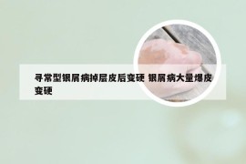 寻常型银屑病掉层皮后变硬 银屑病大量爆皮变硬