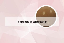 白风癫医疗 白风癫能否治好