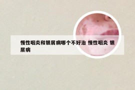 慢性咽炎和银屑病哪个不好治 慢性咽炎 银屑病