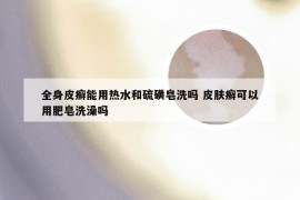 全身皮癣能用热水和硫磺皂洗吗 皮肤癣可以用肥皂洗澡吗