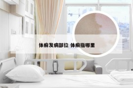 体癣发病部位 体癣指哪里