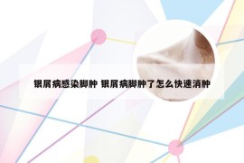 银屑病感染脚肿 银屑病脚肿了怎么快速消肿