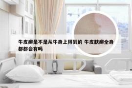 牛皮癣是不是从牛身上得到的 牛皮肤癣全身都都会有吗