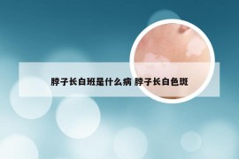 脖子长白班是什么病 脖子长白色斑