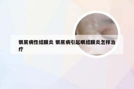 银屑病性结膜炎 银屑病引起眼结膜炎怎样治疗