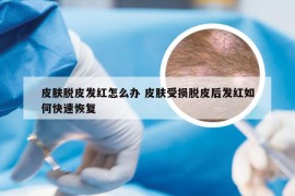 皮肤脱皮发红怎么办 皮肤受损脱皮后发红如何快速恢复