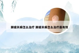 脚底长癣怎么治疗 脚底长癣怎么治疗最有效