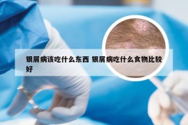 银屑病该吃什么东西 银屑病吃什么食物比较好