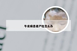牛皮癣患者产检怎么办