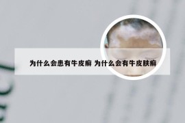 为什么会患有牛皮癣 为什么会有牛皮肤癣