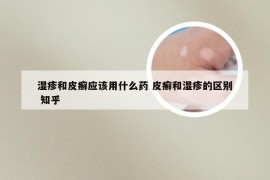 湿疹和皮癣应该用什么药 皮癣和湿疹的区别 知乎