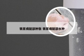银屑病腿部肿胀 银屑病腿部水肿
