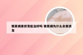 银屑病束状发能治好吗 银屑病为什么会束状发
