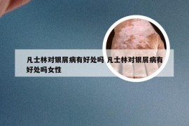 凡士林对银屑病有好处吗 凡士林对银屑病有好处吗女性