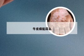 牛皮癣能蒜么