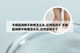 手癣超级痒不除根怎么办,还传染孩子 手癣超级痒不除根怎么办,还传染孩子了