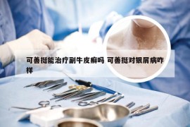 可善挺能治疗副牛皮癣吗 可善挺对银屑病咋样