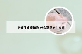 治疗牛皮廨植物 什么草药治牛皮廨