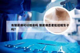 有银屑病可以相亲吗 银屑病患者能结婚生子吗?