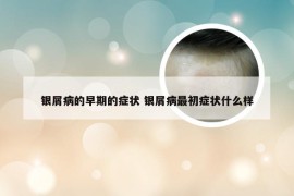 银屑病的早期的症状 银屑病最初症状什么样