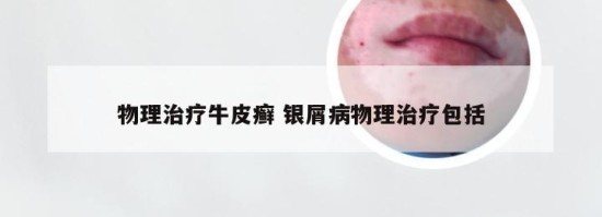 物理治疗牛皮癣 银屑病物理治疗包括