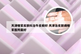 天津哪家皮肤科治牛皮癣好 天津治皮肤病哪家医院最好