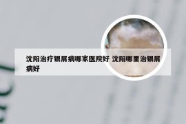 沈阳治疗银屑病哪家医院好 沈阳哪里治银屑病好