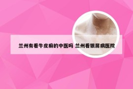 兰州有看牛皮癣的中医吗 兰州看银屑病医院