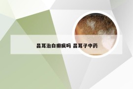 昌耳治白癫疯吗 昌耳子中药