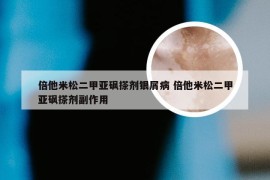 倍他米松二甲亚砜搽剂银屑病 倍他米松二甲亚砜搽剂副作用