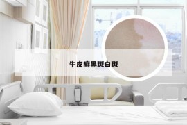 牛皮癣黑斑白斑