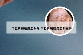 下巴长癣起皮怎么办 下巴长癣脱皮怎么回事