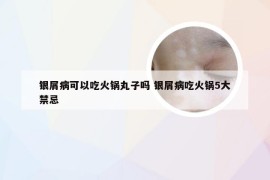 银屑病可以吃火锅丸子吗 银屑病吃火锅5大禁忌