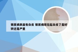 银屑病表面有白皮 银屑病现在起白皮了是好转还是严重