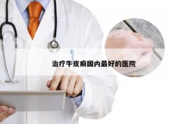 治疗牛皮癣国内最好的医院