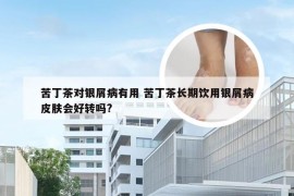 苦丁茶对银屑病有用 苦丁茶长期饮用银屑病皮肤会好转吗?
