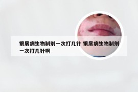 银屑病生物制剂一次打几针 银屑病生物制剂一次打几针啊