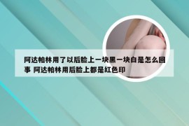 阿达帕林用了以后脸上一块黑一块白是怎么回事 阿达帕林用后脸上都是红色印