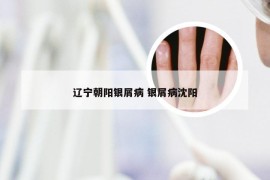 辽宁朝阳银屑病 银屑病沈阳