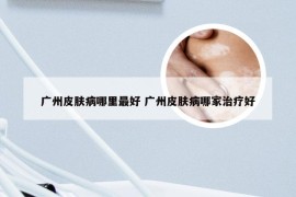 广州皮肤病哪里最好 广州皮肤病哪家治疗好
